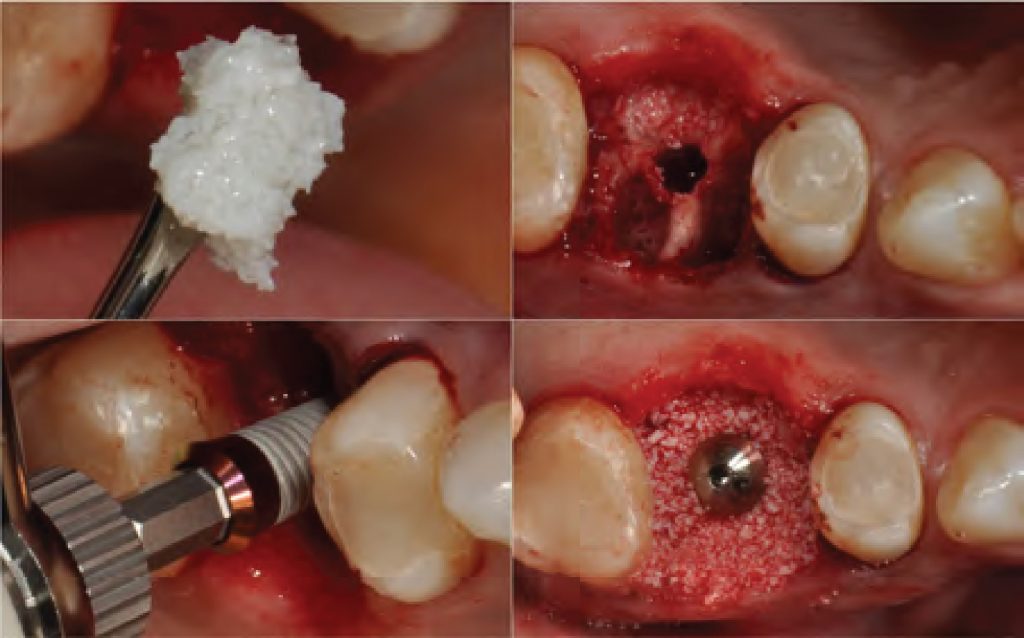 Immediate Implant Placement In Fresh Extraction Sockets Using The Open