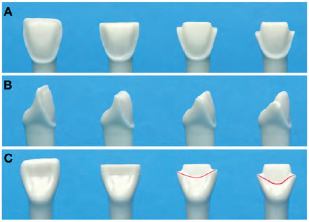 Partial Ceramic Crowns Esthetic And Tissue Conservative Restorations Part Ii Anterior Teeth